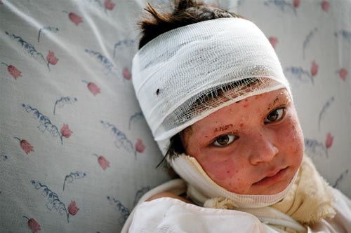 A sad-eyed little girl lies on a bed, her face and head bandaged. Her eyebrows have been singed off.