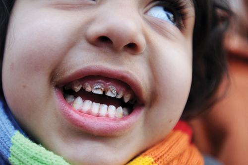 Many of the children in the Osterrode Resettlement Camp have so much lead in their food and drinking water that it leaches from their teeth and rots their gums.